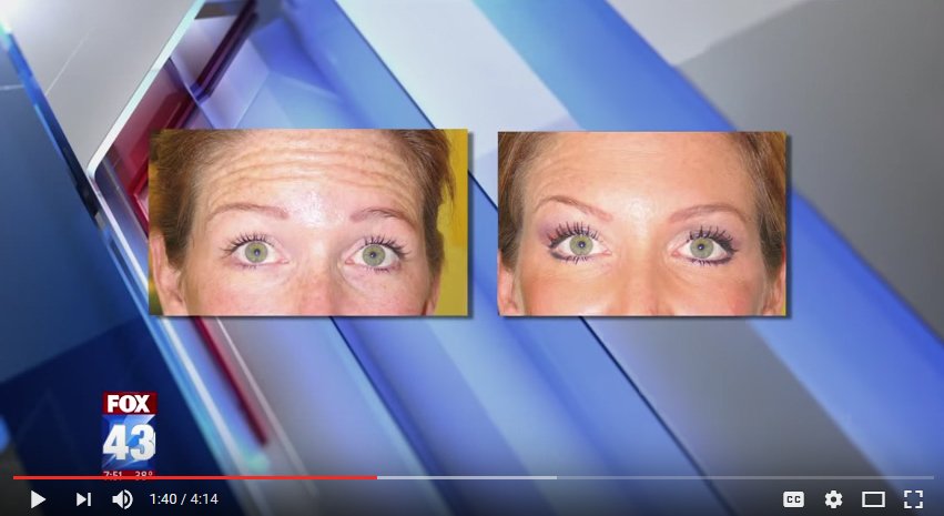Dr_Bruce_Freund's tweet photo. Heard of #Botox ? How about #Xeomin? A news anchor gets treatment for #expressionlines &amp; #wrinkles https://t.co/AgpUeuY3hl #botox #dysport https://t.co/TuyWWq5uqT