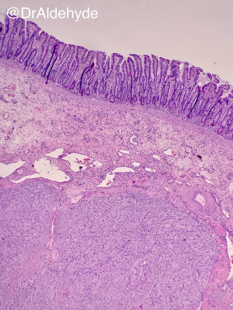 DrAldehyde's tweet photo. Small intestinal GIST. Risk of aggressive behavior predicted by anatomic site, tumor size, &amp; mitotic rate (>5/50 HPF). #gipath #GIST #DOG1 https://t.co/h4MDCQxFC3