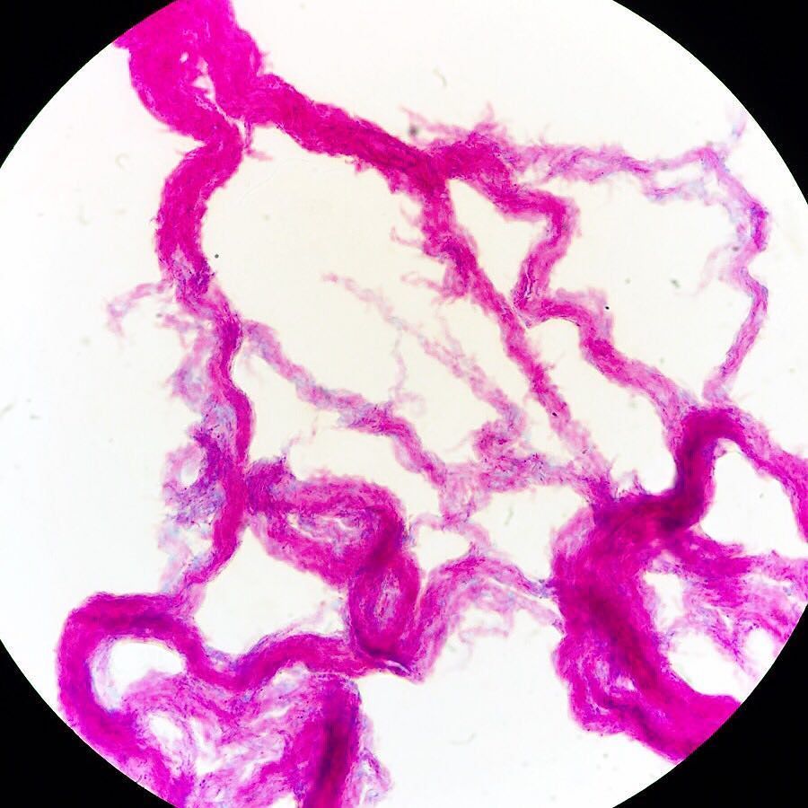 glomerulove's tweet photo. 🔌 #cording 🔌 in Mycobacterium tuberculosis #mycobacteriumtuberculosis #mycobacterium  #tuberculosis #pathology #mi… https://t.co/ZIXRMfIda0 https://t.co/220PmRbmrC