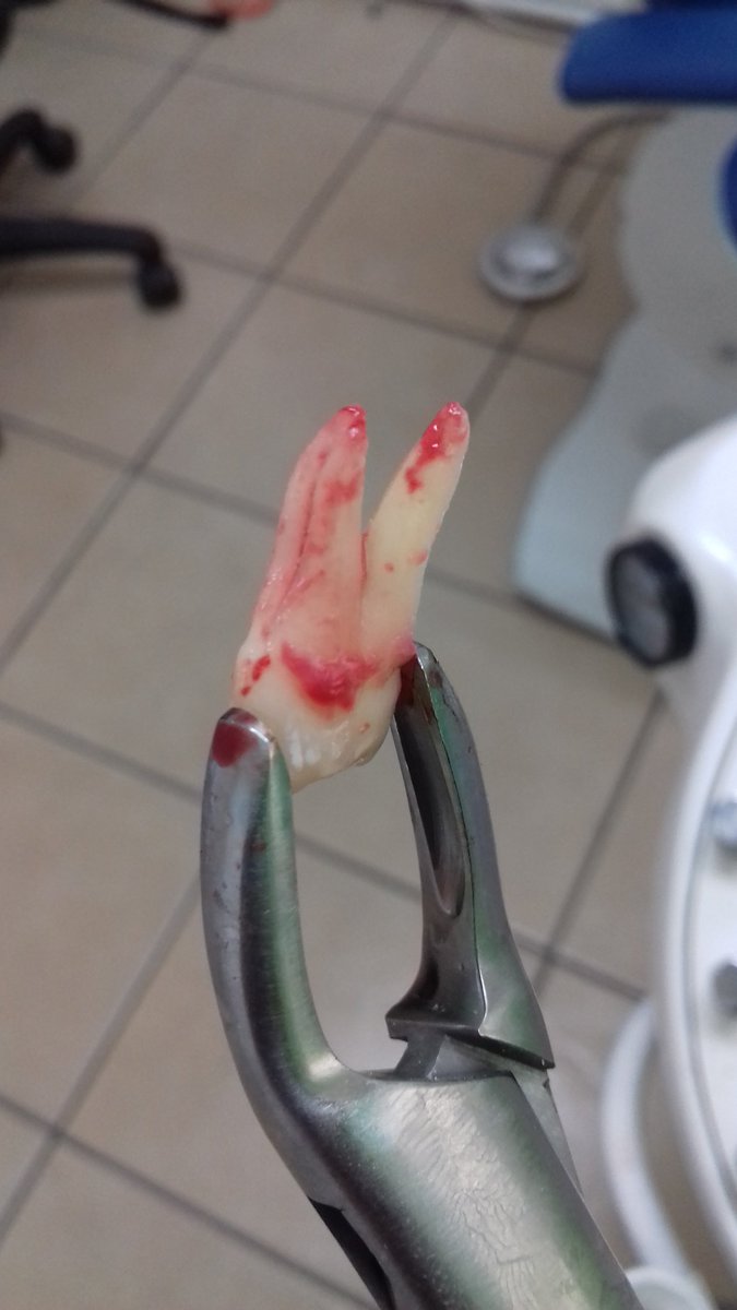 Martes exo 1.4 #dentist #Dentistslife