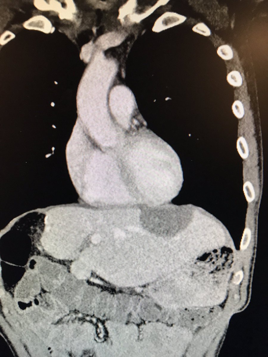 How close to the heart can you ablate without causing trouble.....