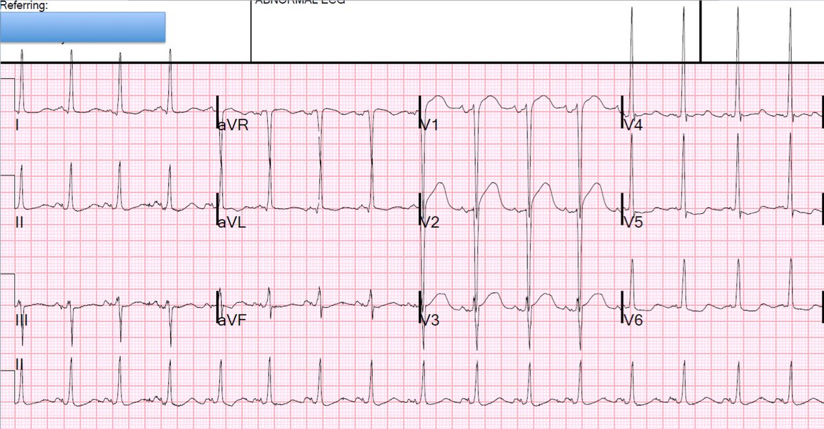 A 60-something with Syncope, LVH, and convex ST Elevation hqmeded-ecg.blogspot.com/2017/04/a-60-s…