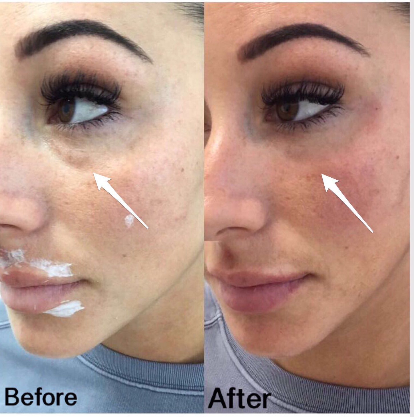 Arriba 92+ Foto Under Eye Filler Before And After Lleno