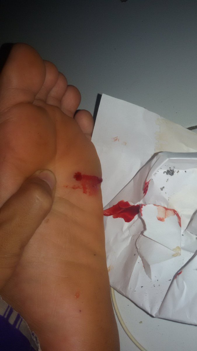 Neackragieldwe's tweet image. Tak tahu knpa ..??
Saat ku ambil daging kecil mirip isi jerawat tiba2 darah keluar bagai tetes embun..!!!