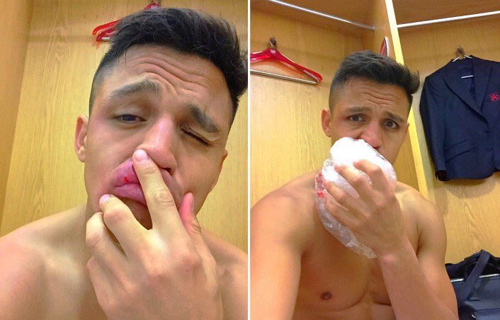 Arsenal players will wear shirts with ’Alexis’ on the back this weekend, in support of his swollen lip.