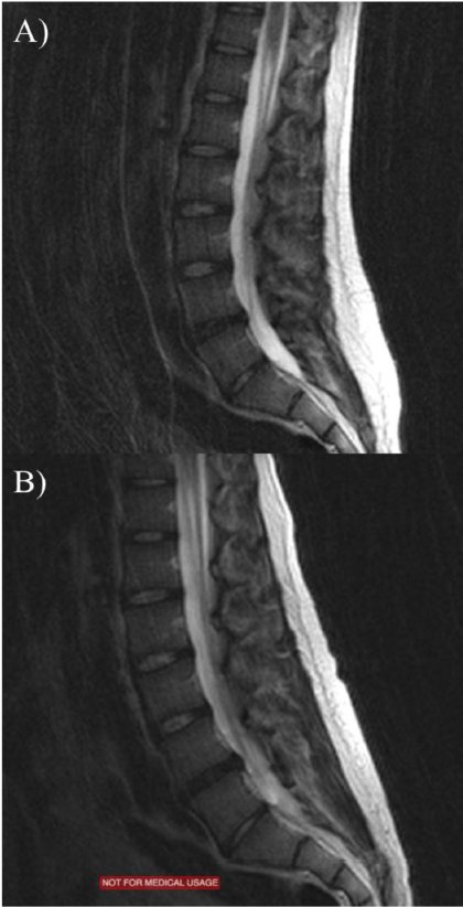 Cool data on lumbar spine responses to upright loading by Ana Rodriguez-Soto (ncbi.nlm.nih.gov/pubmed/27788619)