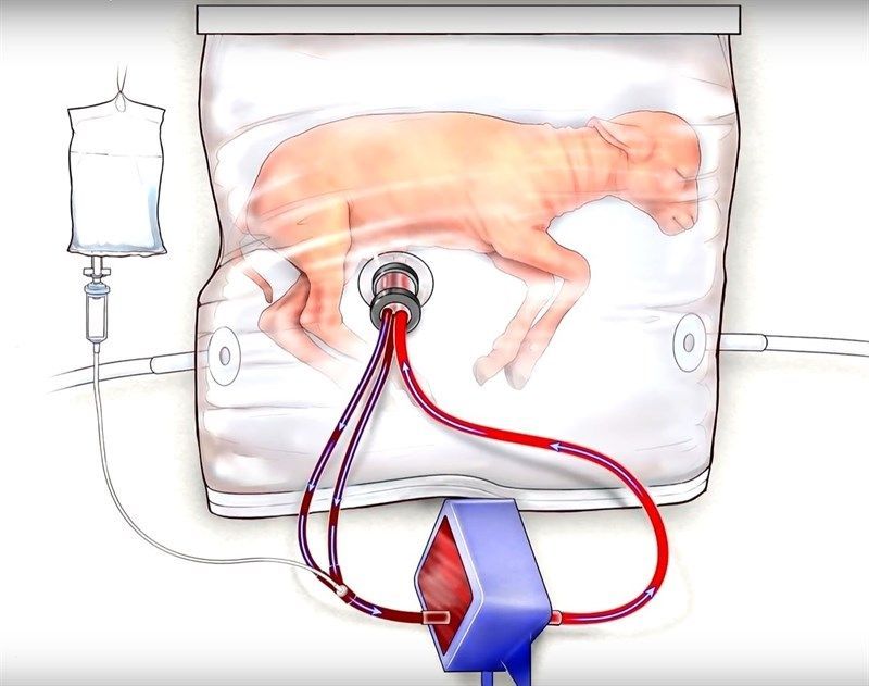 invoxmedical's tweet image. Desarrollan un #úteroartificial que reduce la discapacidad de bebés extremadamente prematuros @infosalus_com buff.ly/2qazh8X