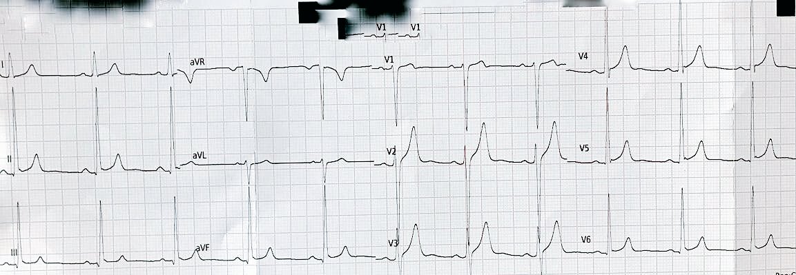 atypicalflutter's tweet image. Asymptomatic Male 30, athletic body, no family SCD. HBV positive. EKG HCM or Not?@ECGcorner @narrowQRS @ECGTalk @drarnelv1