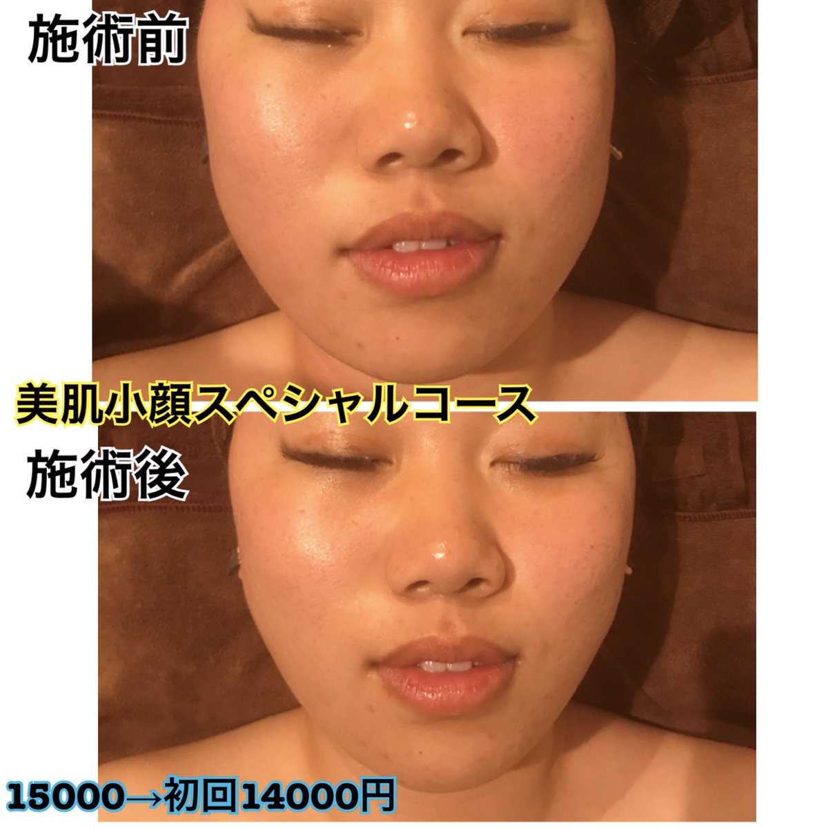 Motto ホワイトニング 脱毛 エステ Auf Twitter お顔のお肉を無くし小さくして顎をvラインにしたいという方にオススメ 1回でこの効果 リンパを流し顎まわりのたるみ 老廃物をしっかり流して 小顔矯正 3種類の機械をかけたら スッキリします お化粧の Motto ホワイトニング 脱毛 エステ Auf Twitter お顔のお肉を無くし小さくして顎をvラインにしたいという方にオススメ 1回でこの効果 リンパを流し顎まわりのたるみ 老廃物をしっかり流して 小顔矯正 3種類の機械をかけたら スッキリします お化粧の
