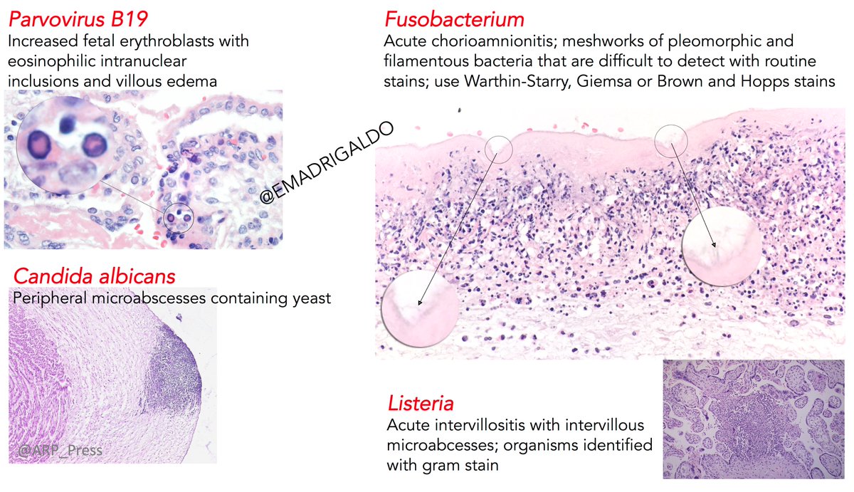 EMadrigalDO's tweet photo. Infectious conditions of the #placenta 

#pathboards #pedipath #microbiology #medEd https://t.co/6IViV4x8UZ