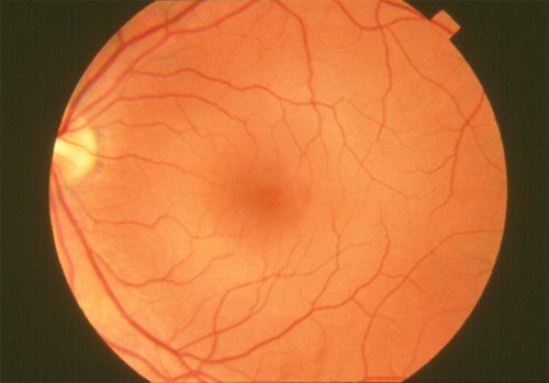 Retinal Detachment is when the #retina pulls/lifts from its normal position. Quick treatment can save vision. More: go.usa.gov/czADm