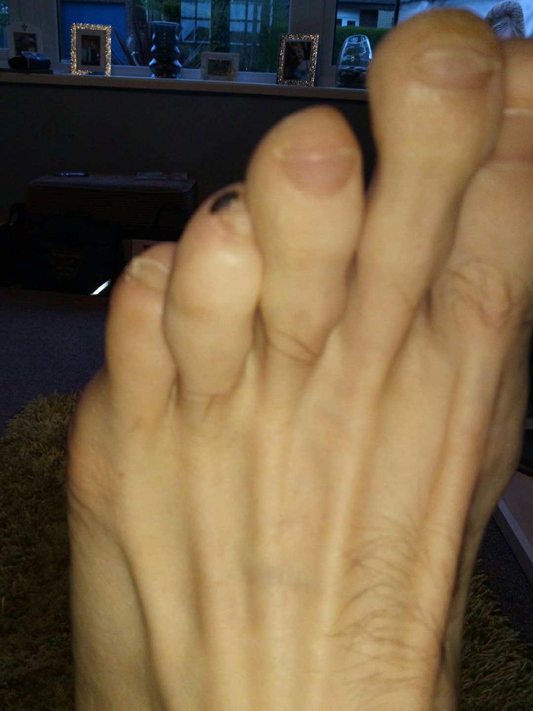 Popping 2024 blood blister