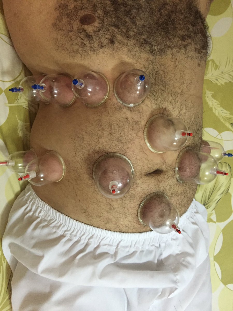 حجامه لعلاج الكبد الدوحه قطر جوال ٧٧٠٠٢٧٤٠