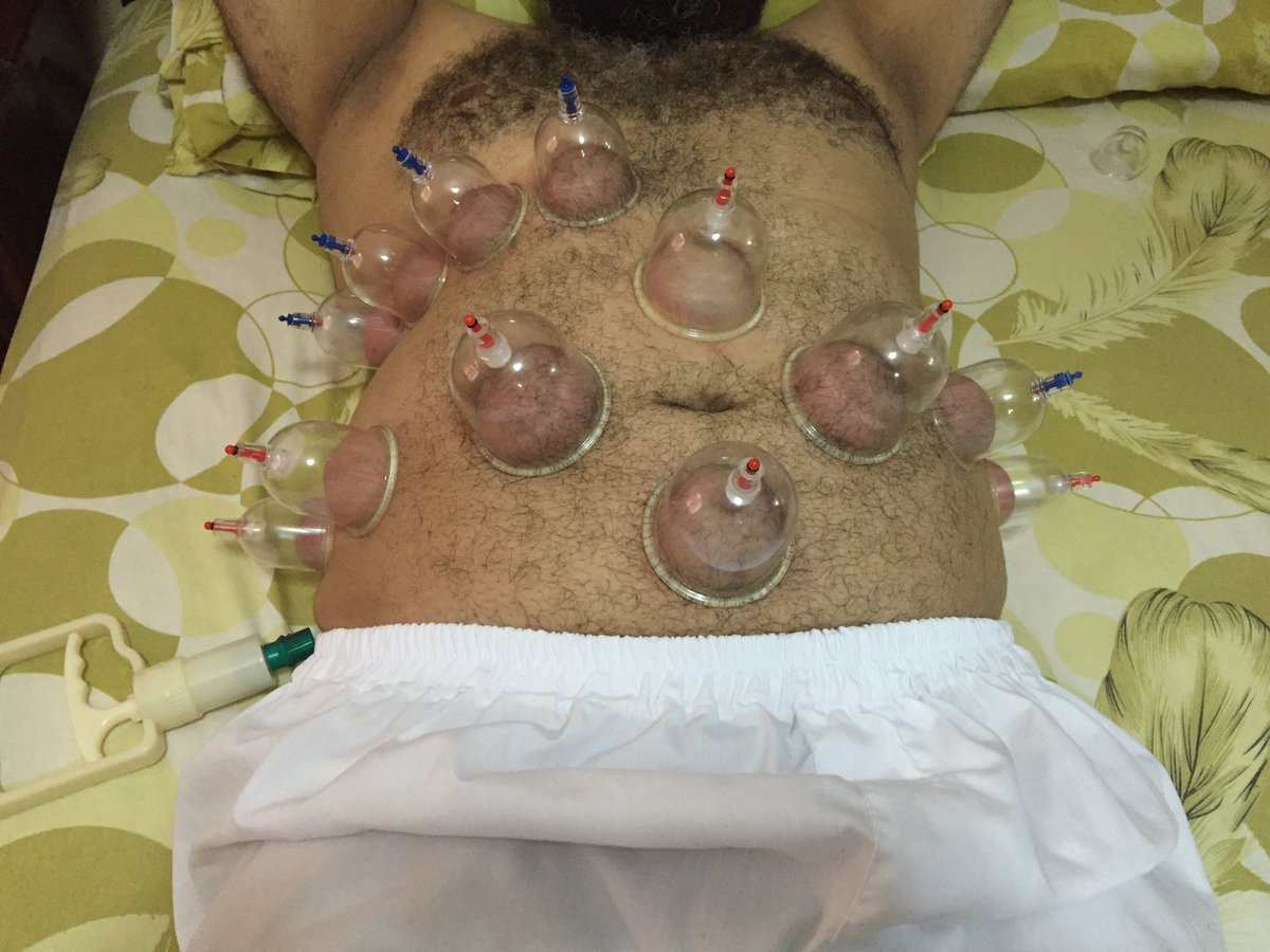 حجامه لعلاج الكبد والقولون العصبي الدوحه ٧٧٠٠٢٧٤٠
