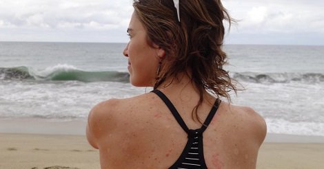 NPF's tweet image. A natural and practical approach to coping with PsO. ow.ly/ZZSY30b8fdf