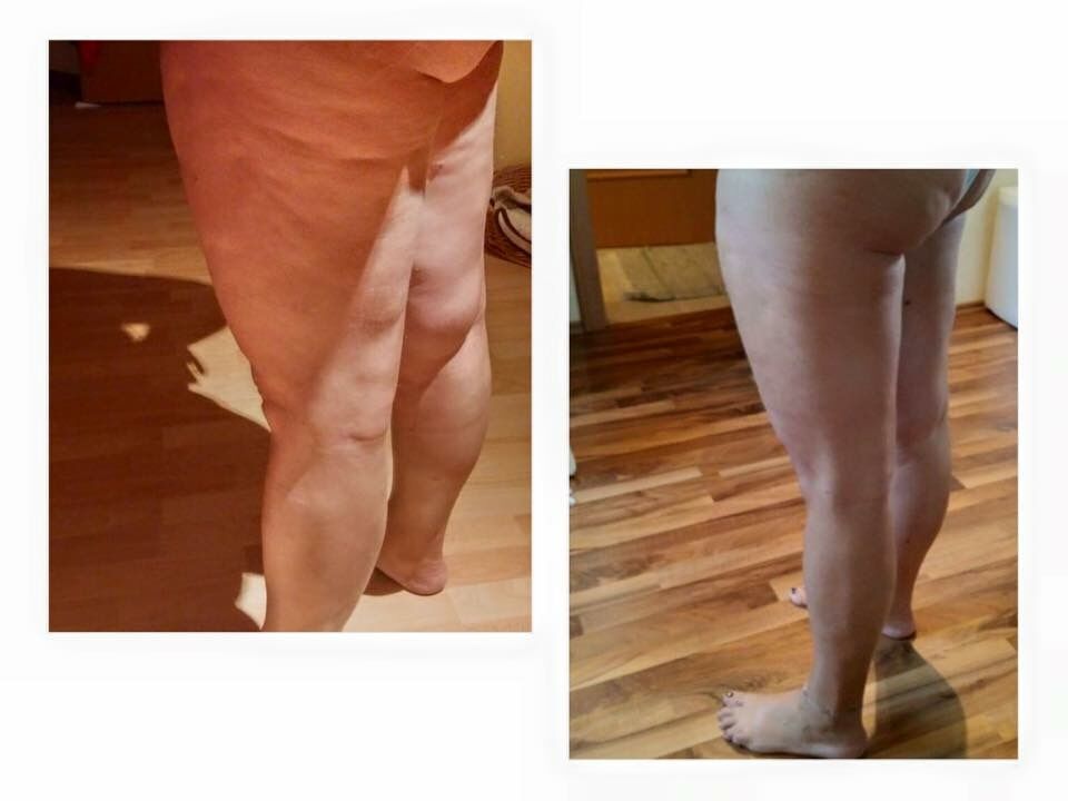 WiebkeStephani's tweet image. #juchheim #schönheitsop #fettabsaugung #schönheit #kosmetik