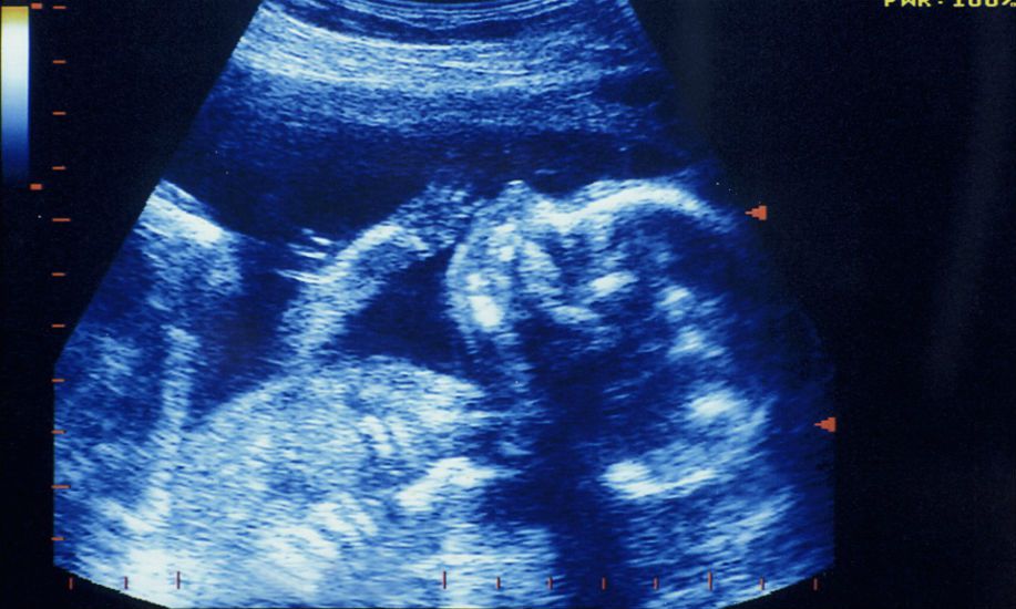 bindeshy6's tweet image. How artificial wombs will change our ideas of gender, family and equality news24one.com/social/artific…