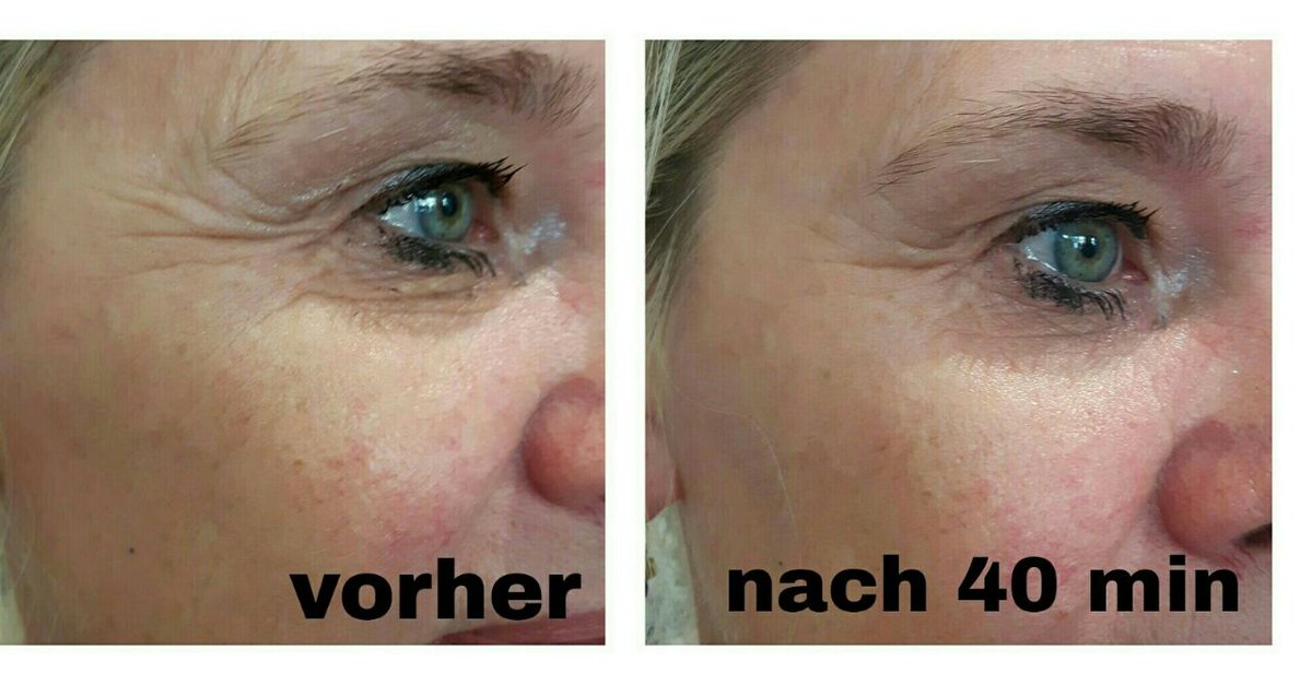 WiebkeStephani's tweet image. stephani.juchheim-methode.de

#juchheim #lifting #schönheitsop #fettabsaugung #kosmetik #effektkosmetik