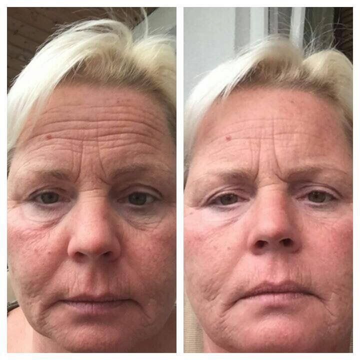 WiebkeStephani's tweet image. Nach 30 min Einwirkzeit! 

stephani.juchheim-methode.de

#juchheim  #schönheitsop  #fettabsaugung #schönheit  #kosmetik  #effektkosmetik