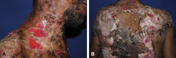 A case of autoinflammatory skin and bone disease flared by a change in osteoporosis management ow.ly/5EqF30apJuV