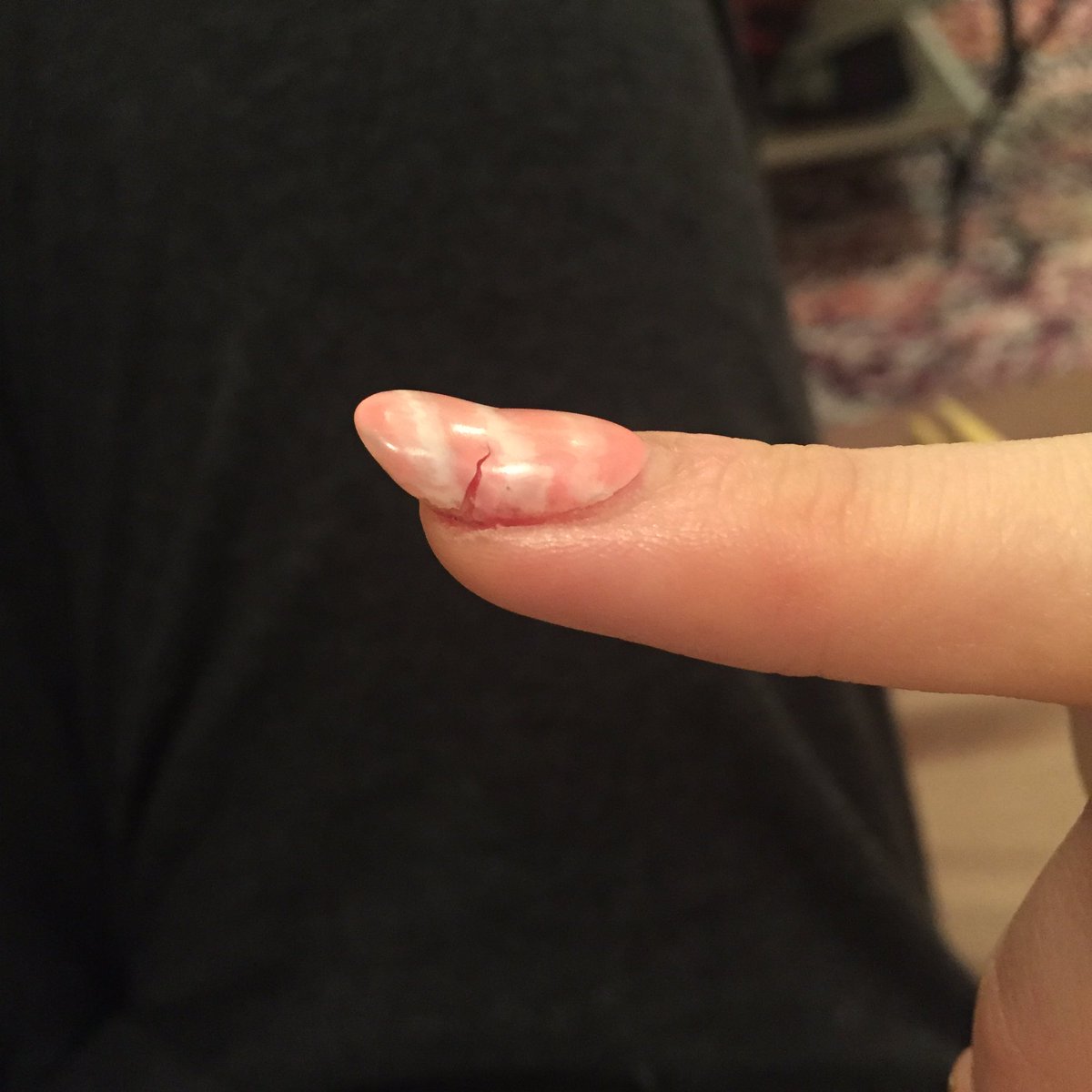 こぼ 職場で重たいダンボール運んだら爪割れた ライブのモッシュはわりと平気なのに爪から血が滲む様子みて貧血で立ちくらみするとか自分の体謎 こぼ 職場で重たいダンボール運んだら爪割れた ライブのモッシュはわりと平気なのに爪から血が滲む様子みて貧血で立ちくらみするとか自分の体謎