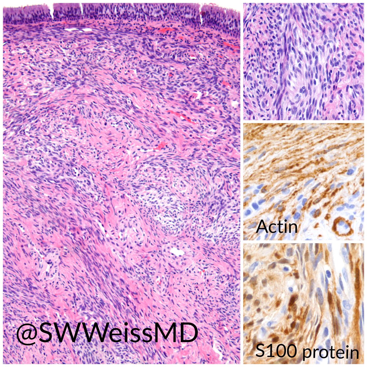 Nasal mass in adult. Answer coming soon #BSTPath