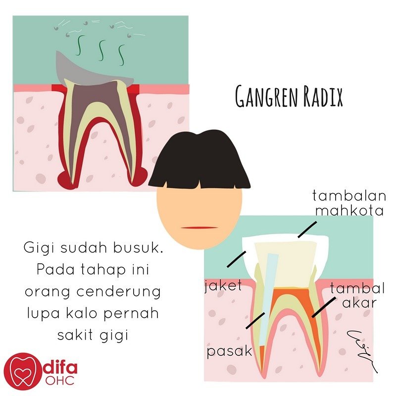 Hasil gambar untuk gambar gangren pulpa