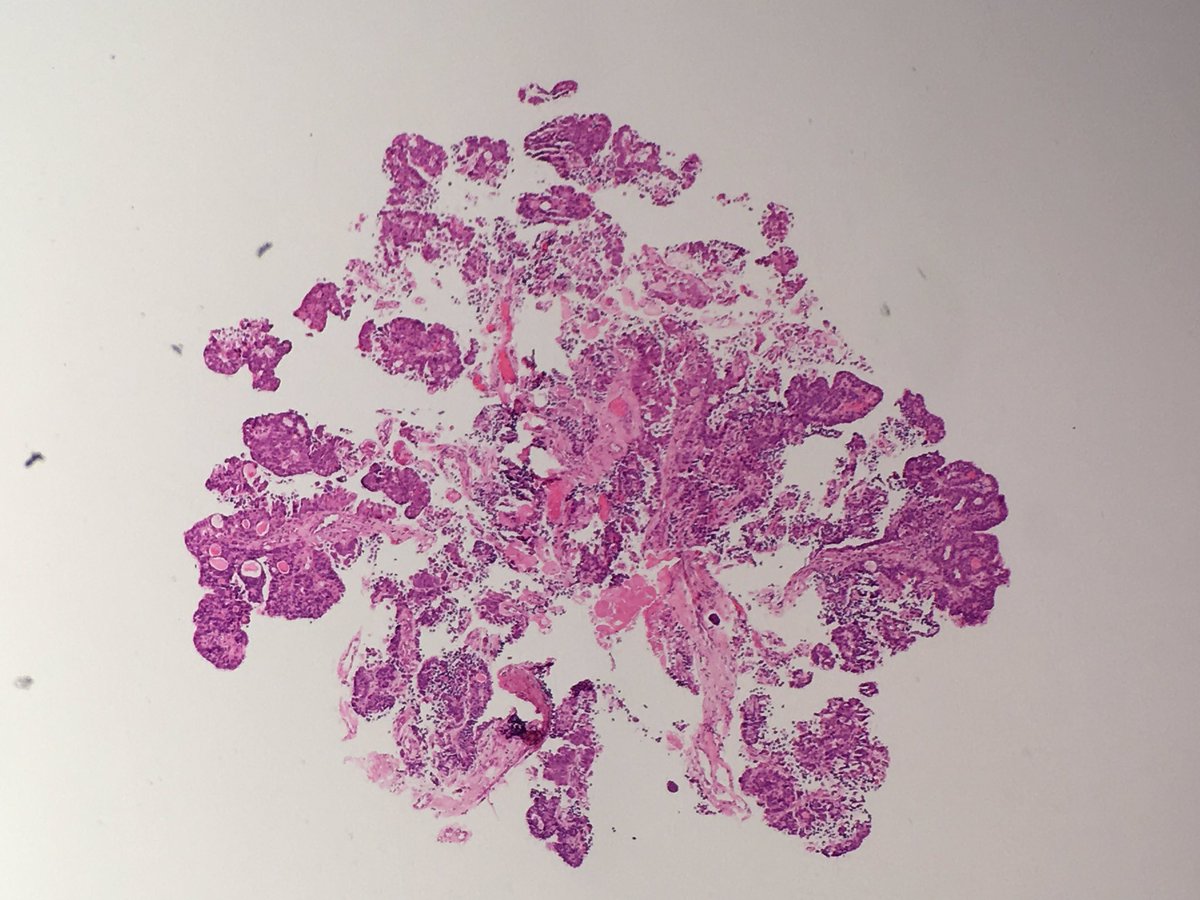 drjamescarton's tweet image. Bx from renal pelvic lesion any thoughts from #gupath community?