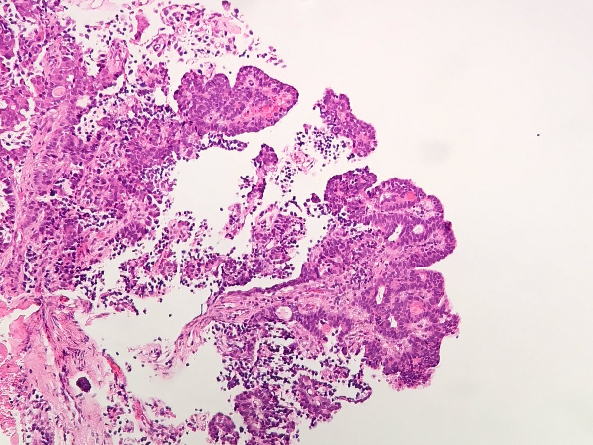drjamescarton's tweet image. Bx from renal pelvic lesion any thoughts from #gupath community?