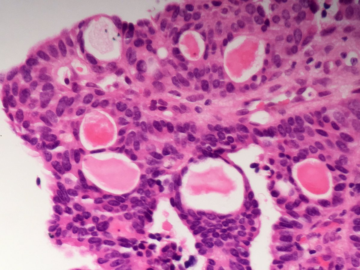 drjamescarton's tweet image. Bx from renal pelvic lesion any thoughts from #gupath community?