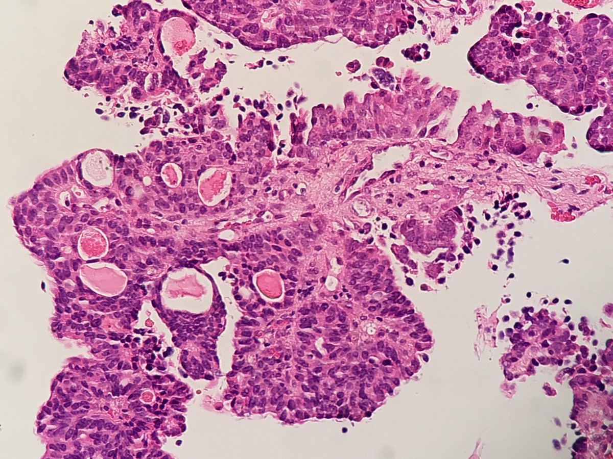 drjamescarton's tweet image. Bx from renal pelvic lesion any thoughts from #gupath community?