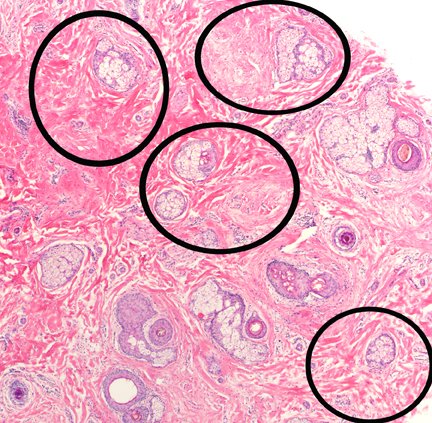 LenSperling's tweet image. When all the histo findings cannot be explained by one diagnosis, think multifactorial alopecia. Attached: androgenetic AND traction