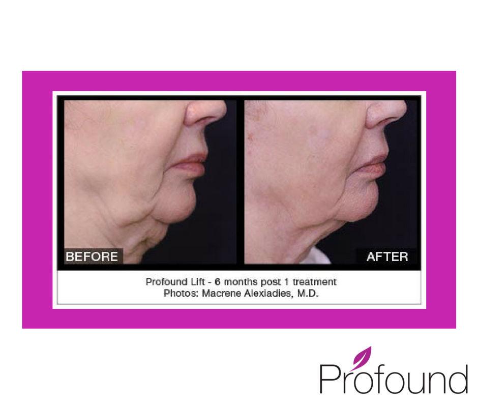 ProfoundLift's tweet image. A Before &amp;amp; After pic speaks louder than words. These are a Profound® Lift patient’s results after 1 treatment bit.ly/2dfFwPG