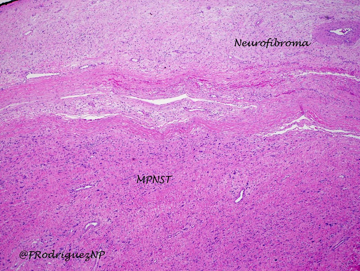 FRodriguezNP's tweet image. Supraclavicular mass in pt with #neurofibromatosis type 1: MPNST arising in plexiform neurofib. @neuropathology @neuropathmx #neuropathology