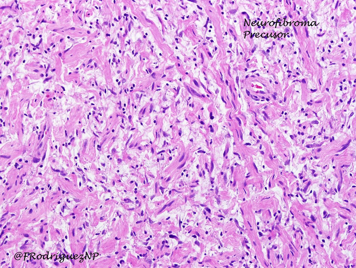 FRodriguezNP's tweet image. Supraclavicular mass in pt with #neurofibromatosis type 1: MPNST arising in plexiform neurofib. @neuropathology @neuropathmx #neuropathology