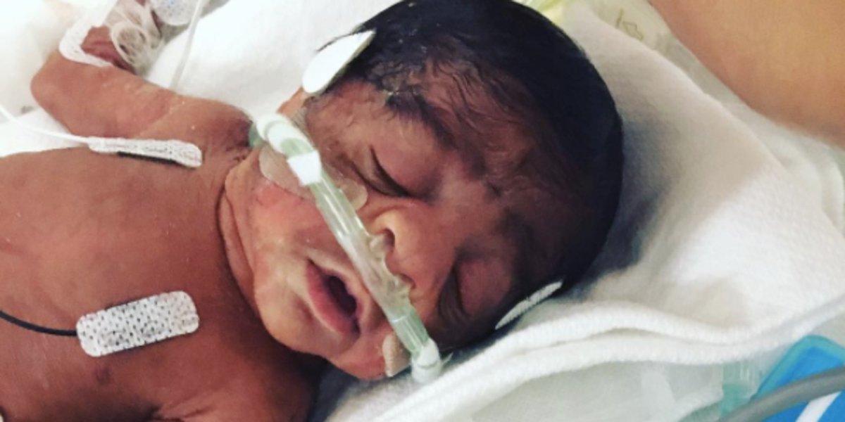 Meet amazing baby Austin, born at 25 weeks. buff.ly/2hQLGYd? #NICU #baby #preemie #parents #family