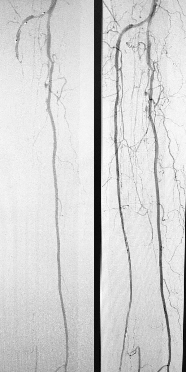 DanHan's tweet photo. Short segment pop atherectomy + Long segment anterior tibial #CTO cross for #CLI non healing 1st toe ulcer. Do you believe in #angiosomes? https://t.co/fp93GlqKE7