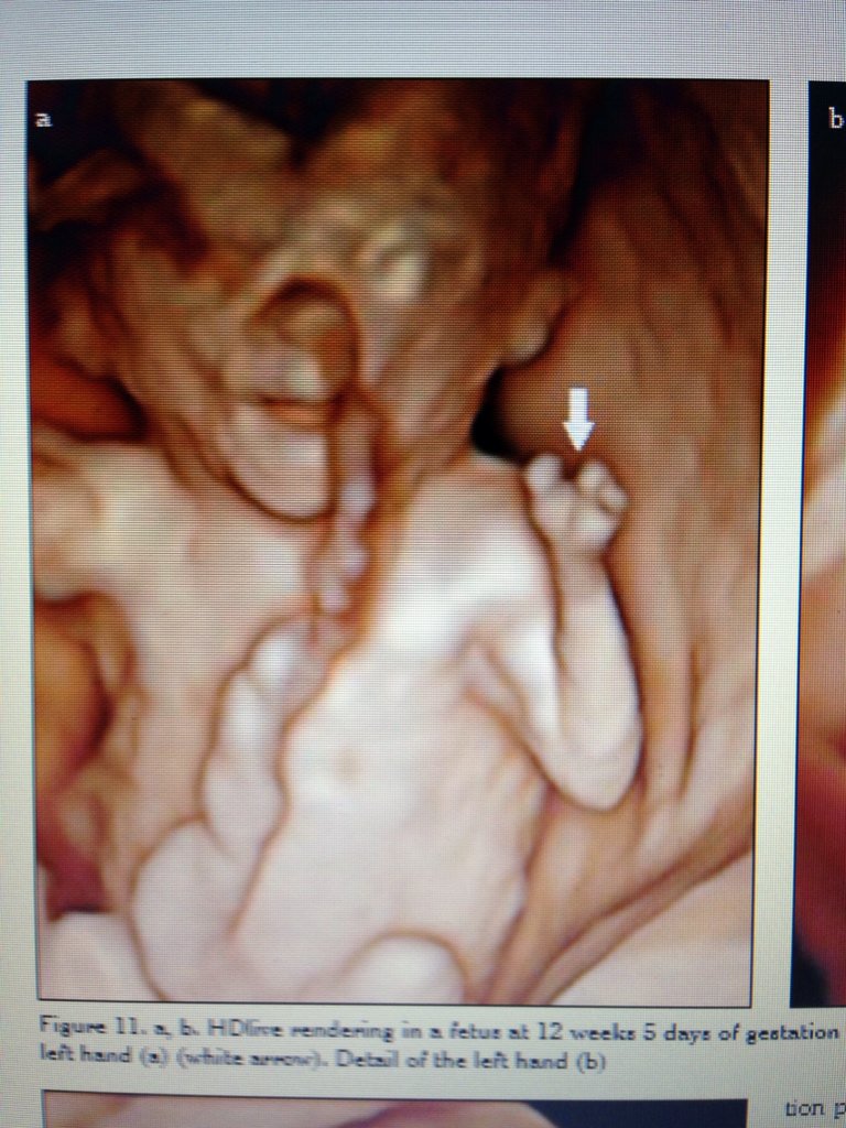 Amniotic Band Syndrome Hand
