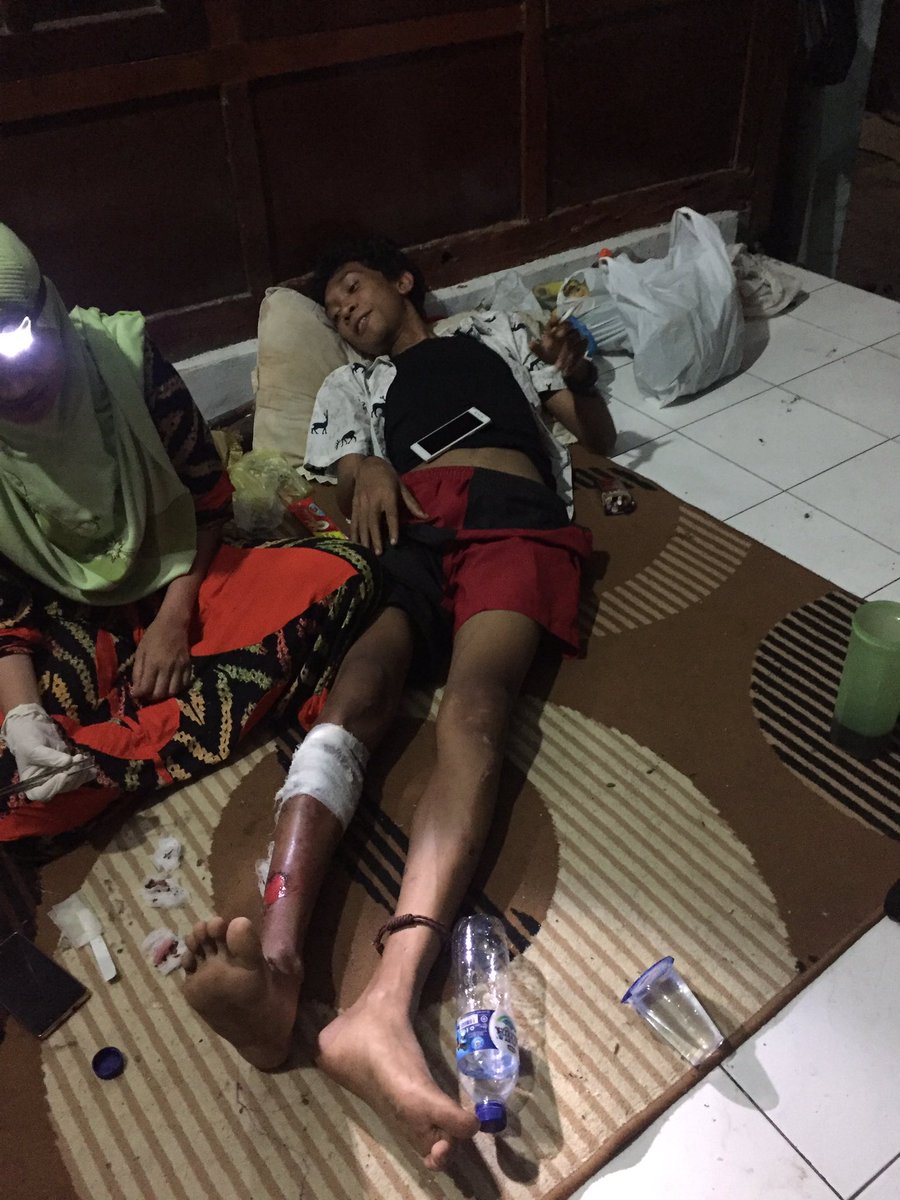 JCI_Bima's tweet photo. Mohon doanya salah satu relawan dari @JCI_Bima mendapat musibah kulit terbakar akibat motor yg di gunakan pada saat baksos  tadi terbakar https://t.co/KhRLWCiiQg