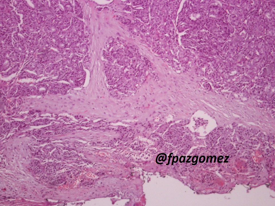 fpazgomez's tweet photo. #Hurtle Cell ( #Oncocytic ) #Carcinoma , #angioinvasion and #capsular invasion
#pathology #pathologist #thyroid #EndoPath #ENTPath https://t.co/oJGxtvShbA