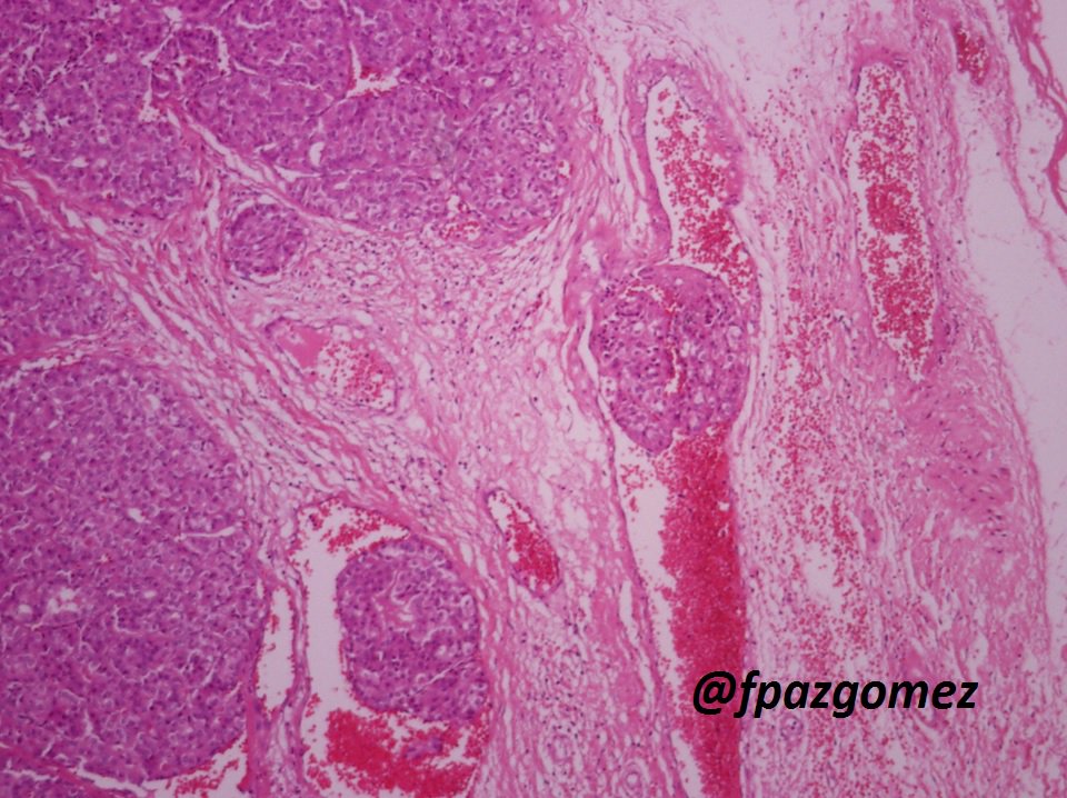fpazgomez's tweet photo. #Hurtle Cell ( #Oncocytic ) #Carcinoma , #angioinvasion and #capsular invasion
#pathology #pathologist #thyroid #EndoPath #ENTPath https://t.co/oJGxtvShbA