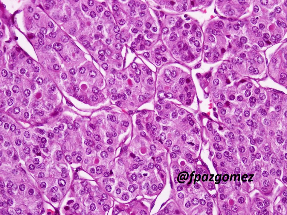 fpazgomez's tweet photo. #Hurtle Cell ( #Oncocytic ) #Carcinoma , #angioinvasion and #capsular invasion
#pathology #pathologist #thyroid #EndoPath #ENTPath https://t.co/oJGxtvShbA