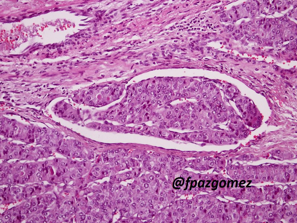 fpazgomez's tweet photo. #Hurtle Cell ( #Oncocytic ) #Carcinoma , #angioinvasion and #capsular invasion
#pathology #pathologist #thyroid #EndoPath #ENTPath https://t.co/oJGxtvShbA