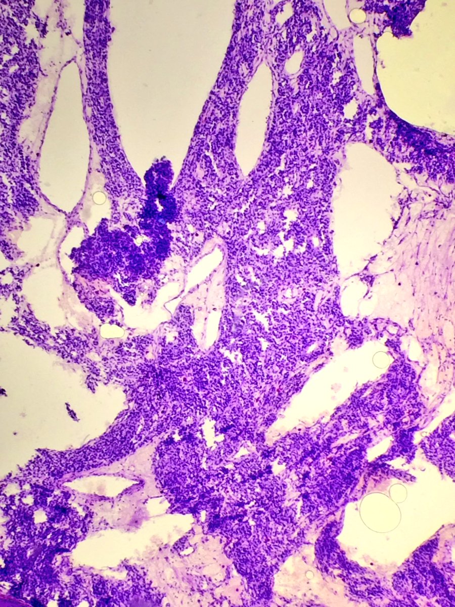 sam_albadri's tweet image. Carotid body paraganglioma #Tolblue @PathologyIsCool @raghupillappa @TheUSCAP @UABPathology @edusqo @DraEosina #patholo