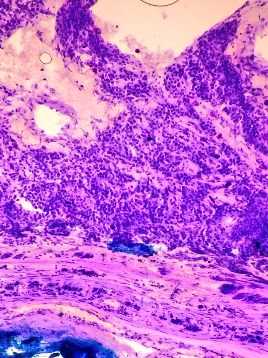 sam_albadri's tweet image. Carotid body paraganglioma #Tolblue @PathologyIsCool @raghupillappa @TheUSCAP @UABPathology @edusqo @DraEosina #patholo
