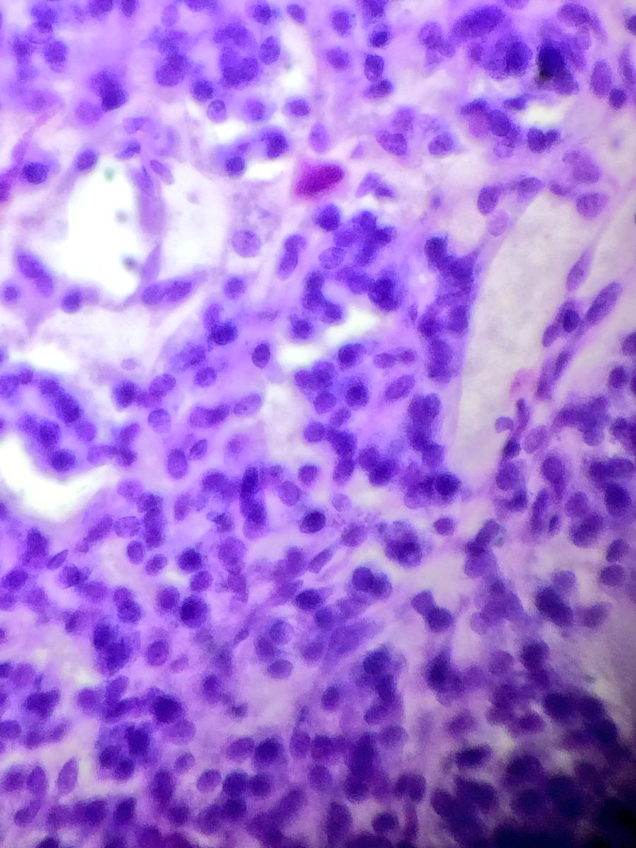 sam_albadri's tweet image. Carotid body paraganglioma #Tolblue @PathologyIsCool @raghupillappa @TheUSCAP @UABPathology @edusqo @DraEosina #patholo