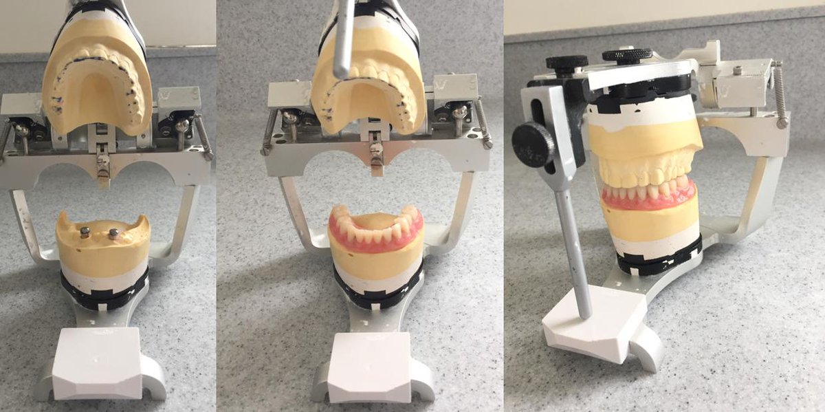 Implant retained denture finished for Xmas. This patient will be able to enjoy their turkey etc with no worries about being unable to chew.