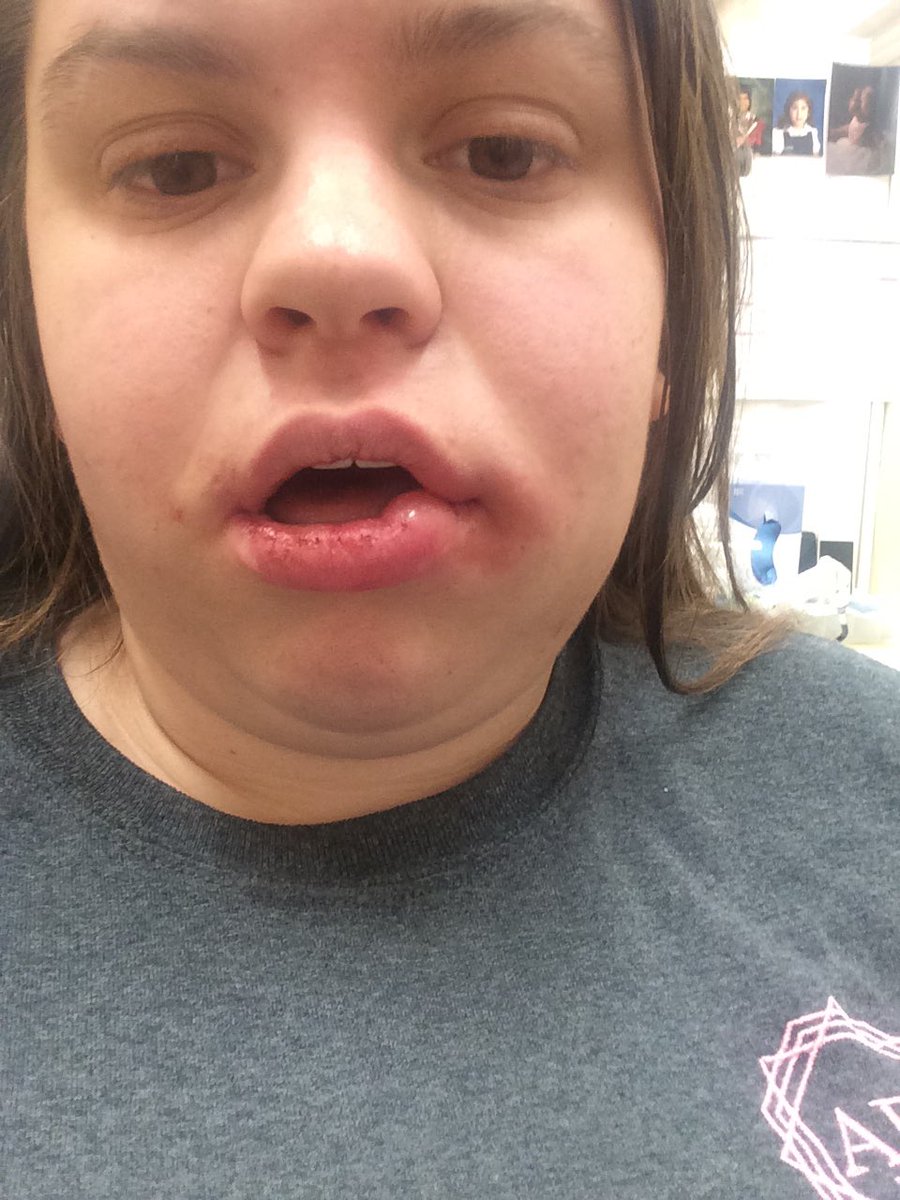 itsyourdest's tweet image. You should see the other guy.
#wisdomteethprobs #surgery