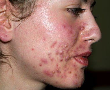 Healthkept's tweet image. #Acne Is more annoying , now you can get rid of it safetly 
read more &amp;gt;&amp;gt; clickmeterlink.com/acnenomore 
#skincare #skin