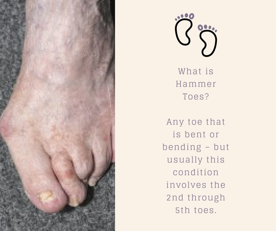 Afraid you may have #HammerToes? See the symptoms and how you can treat this common foot condition: ow.ly/dxsc306Q91K